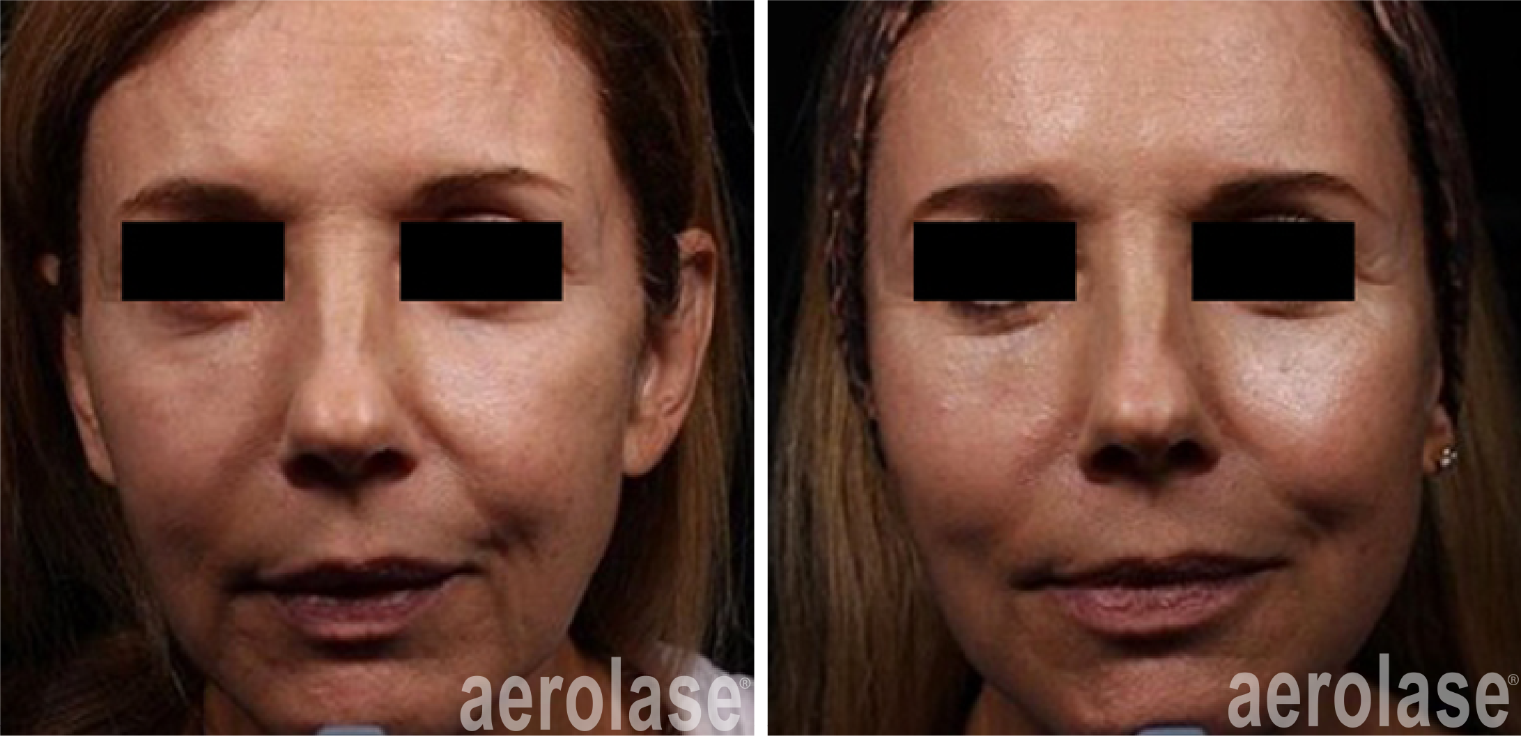 After 2 Treatments Combined with Filler